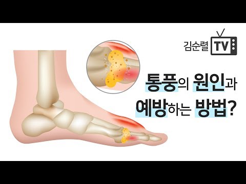 Causes and Prevention of Gout [Dr. Kim Soon-ryul, Doctor of Oriental Medicine]