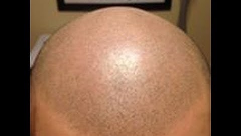 Scalp MicroPigmentation  training - 3DScalpMicroPigmentation.com