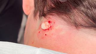 Neck Cyst