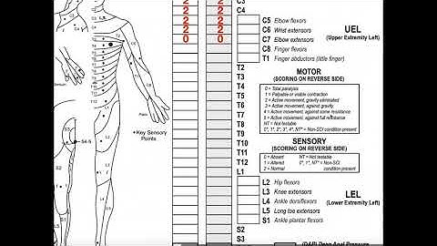 Classifying Spinal Cord Injuries using ASIA Scoring [Explanation + Example 1]