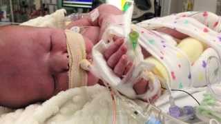 3D Printer Helps Babies Breathe