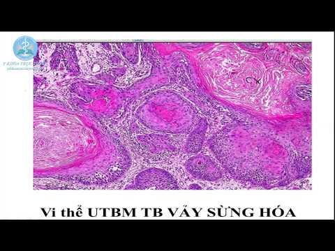 Video Ung thư biểu mô tế bào vảy - Thực hành giải phẩu bệnh - youtube
