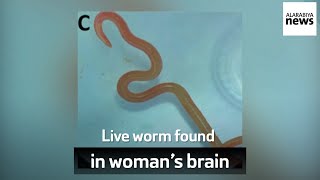 Live worm found in woman’s brain