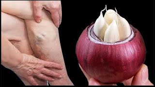 Leg pain, rheumatism, varicose veins, arthritis, headaches, joint pain. Mom's natural remedies