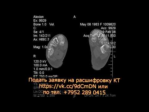 Травма стопы с переломом и отеком мягких тканей на расшифровке КТ стопы