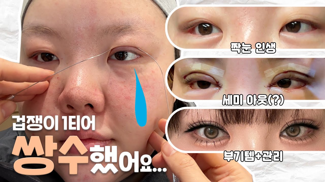 *농 안치고 쌍수 10년 고민했습니다. 절개/세미아웃/윗트임/밑트임 한달 차 vlog.(부기템/관리법)