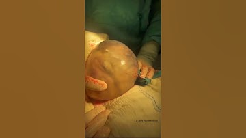 Bayi ini Masih di dalam Kantung Ketuban #edukasikesehatan #kehamilan #hamil