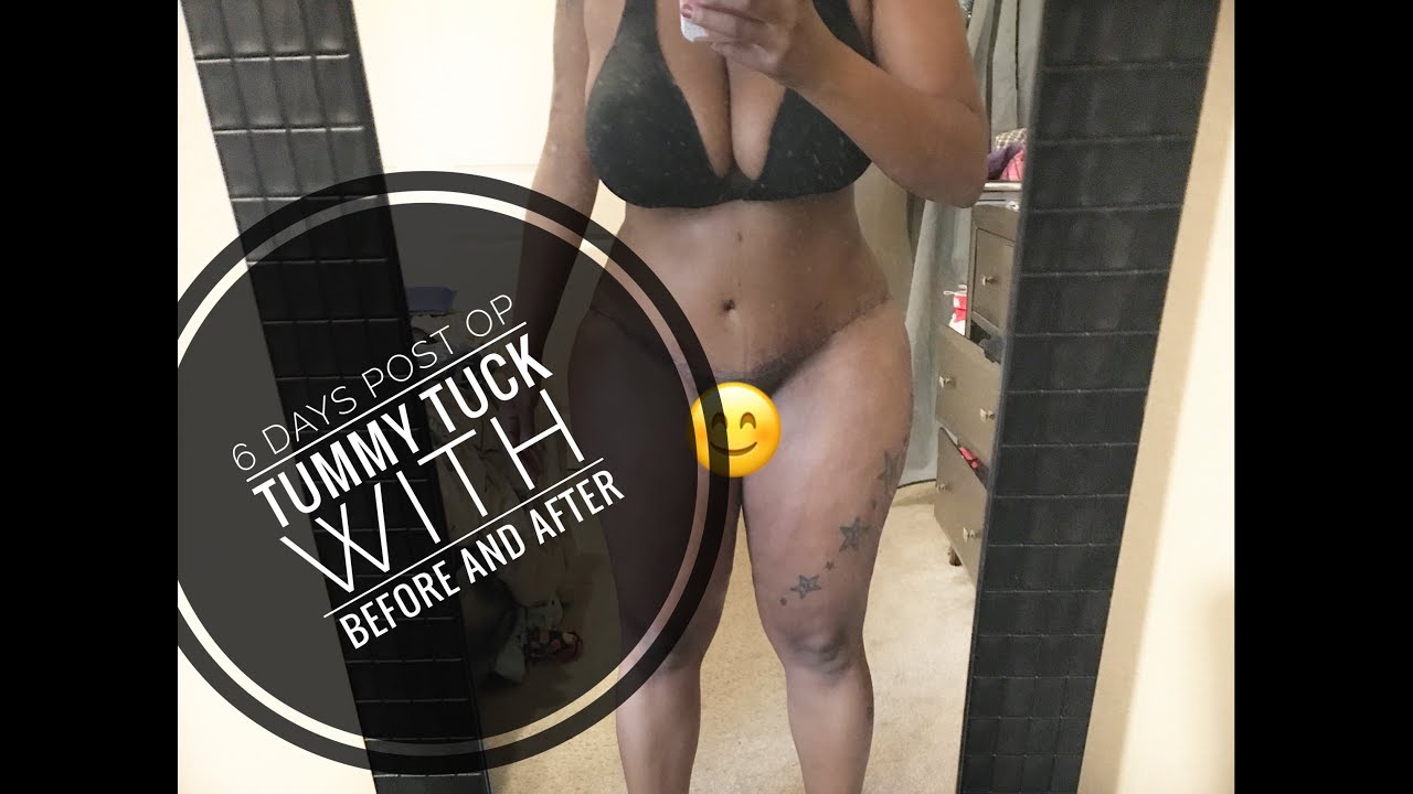 6 Days Post Op Tummy Tuck with Before and After