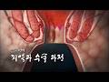 [명의 의학백과📖] 치열과 수술 과정