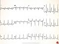 EKG Varios Recopilacion 4