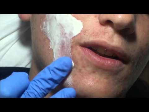 Ángel&#;s Acne Treatment: Home Care