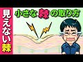 【小さな棘の取り方】見えないトゲの抜き方、除去方法