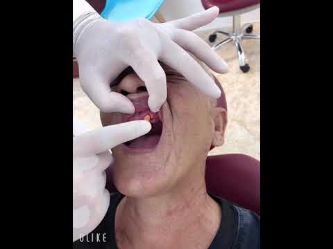 Video Nhổ răng lung lay - youtube