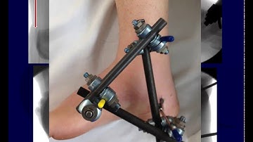 Calcaneal fractures - Treatment goals, emergencies, nonop tx (OTA lecture series IV L15b)
