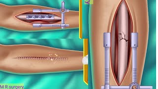 hand bone surgery 3d animation/हाथ की हड्डी की सर्जरी 3डी एनिमेशन/#asmr laser surgery screenshot 5