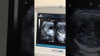 Double bubble/Duodenal Atresia #viralpage2023 #viralvideo #trendingvideo #ultrasound #knowledge