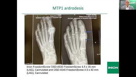 Inion Webinar: Tero Aaltonen - Clinical Experience of Inion FreedomPlate, Screw and Pin