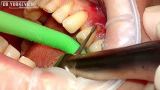 Закрытие одиночной рецессии десны | Забор ССТ через 1 разрез | Single gum recession closure with CTG