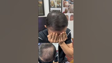 Tóc thưa do rụng tóc nam nữ, chữa mãi không khỏi, xăm tóc liệu có hợp lý #xămtóc #scalp