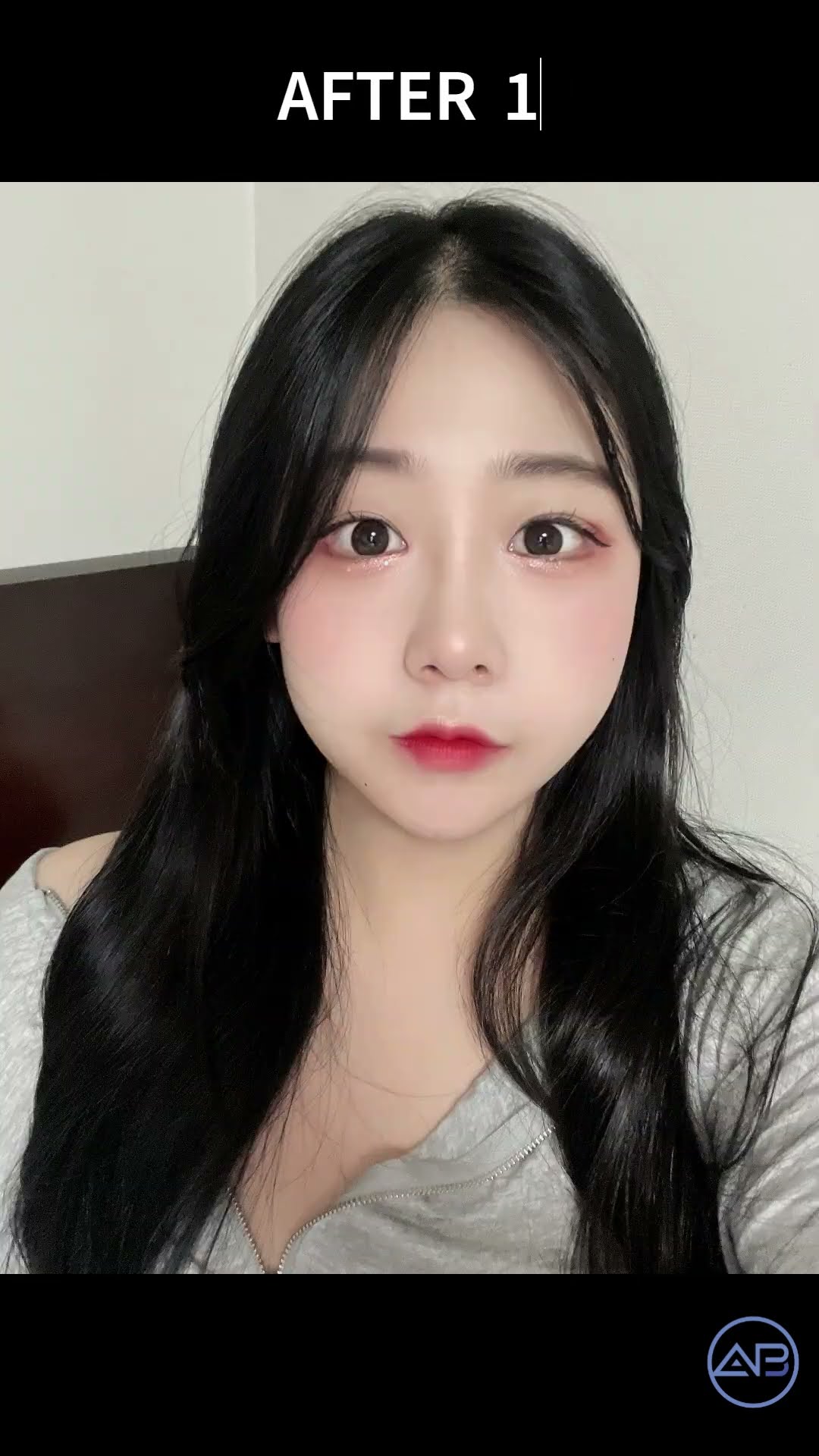 [韓国整形] 目整形 + 鼻整形 #韓国整形外科 #整形レビュー #abplasticsurgery