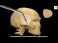 Neurosurgery 3D Animation Video Temporal Craniotomy