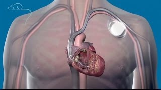 Top ten medical inventions: pacemakers