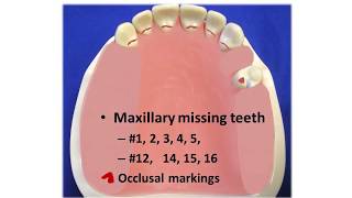 Maxillary Isolated Abutment Design