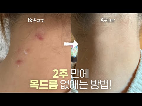 광고❌ 2주 만에 목드름 없애는 방법! 아무도 알려주지 않아서 직접 찾은 찐케어🙆🏻‍♀️ ㅣ HASOMY 하소미