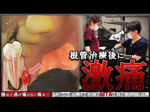 Severe Pain After Root Canal] Dealing with Unbearable Swelling and