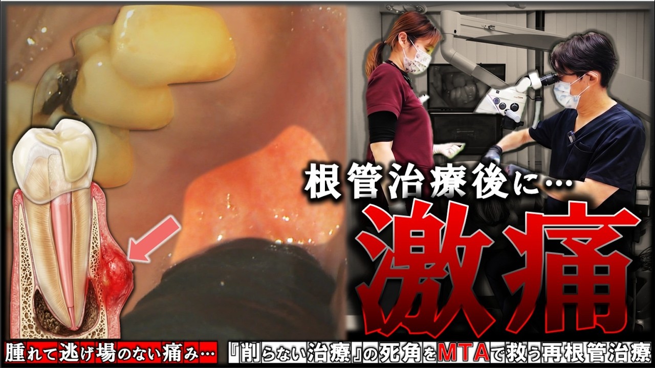 Severe Pain After Root Canal] Dealing with Unbearable Swelling and