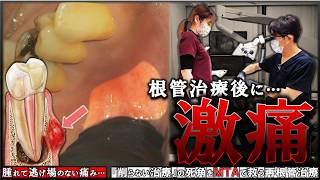 Severe Pain After Root Canal] Dealing with Unbearable Swelling and