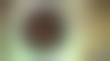 Removal of subluxed crystalline lens and placement of CTR and Ahmed segment