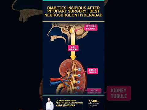 Diabetes Insipidus After Pituitary Surgery | Best Neurosurgeon Hyderabad | తెలుగు