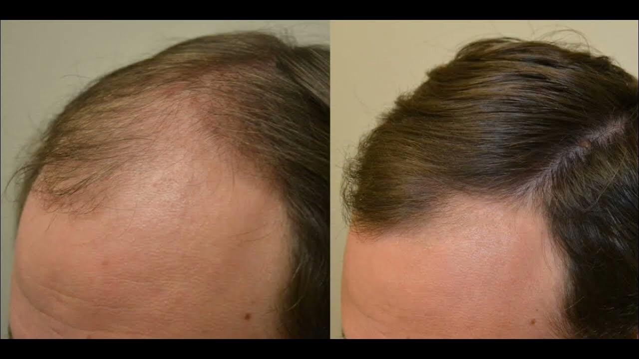 Восстановление выпадения волос