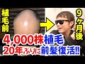 【植毛9ヶ月経過】M字ハゲで諦めてたけど 20年ぶりに前髪復活！【自毛植毛】