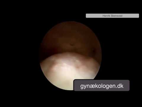 Video: Kjertelfibrøs Polypp I Endometrium: Behandling Etter Fjerning