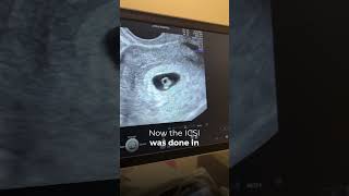 6 Week Scan After Icsiivf
