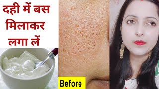 सिर्फ 2 Use मैं चेहरे से Open pores झाइयां और छोटे-छोटे फेशियल हेयर जड़ से खत्म करें ?