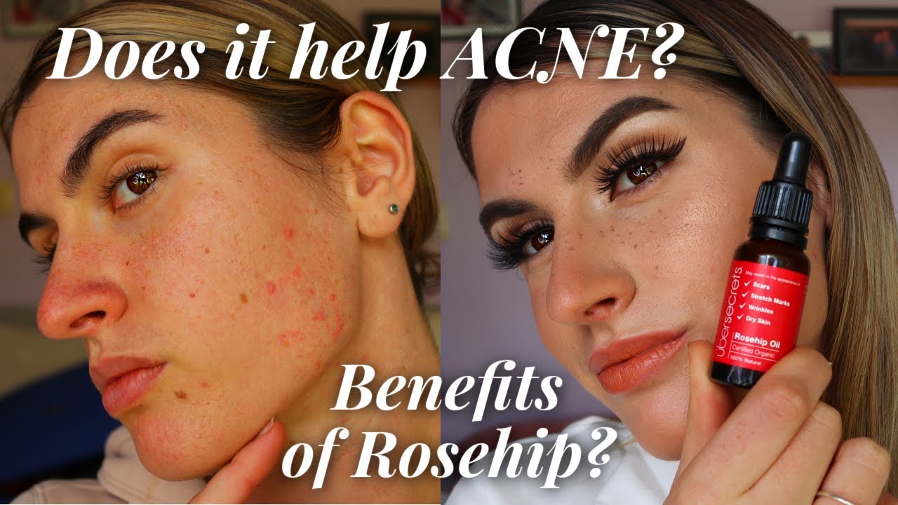 Ubersecrets ROSEHIP OIL Review for ACNE Prone Skin - YouTube