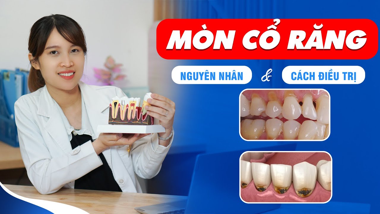 Outline Video Mòn Cổ Răng - Nguyên Nhân & Cách Điều Trị | Nam Bùi Vinalign