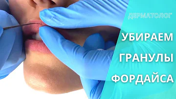 ГРАНУЛЫ ФОРДАЙСА: что это такое и надо ли их удалять. Врач-дерматовенеролог | КЛИНИКА MEDICRIS
