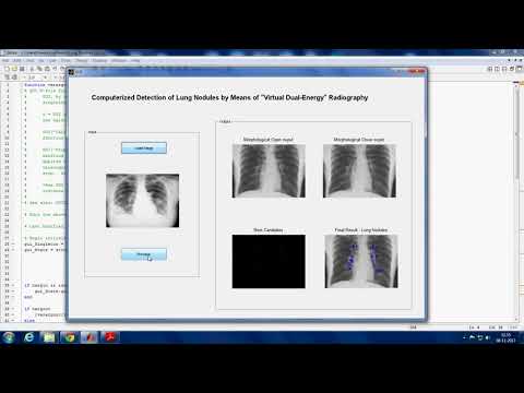Detection of Lung Nodules