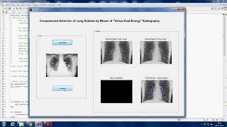 Detection of Lung Nodules