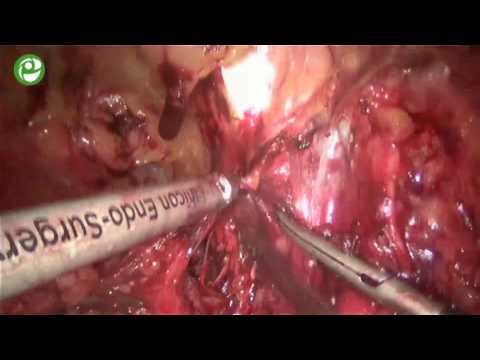 Секция живой хирургии: Простатэктомия