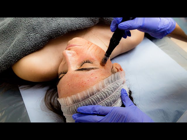 CO2 Laser Recovery - What to expect after the treatment 