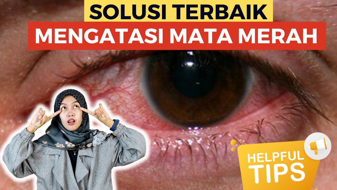 CARA MENGOBATI dan MENYEMBUHKAN MATA MERAH/MATA IRITASI/MATA BELEKAN