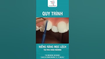 Quy trình niềng răng mọc lệch | Nha khoa MARINA #nhakhoamarina #dentist #niengrang #chinhnha