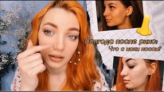 Видео ПЕРЕСТАЛ ДЫШАТЬ НОС И ПОЯВИЛАСЬ ГОРБИНКА / полгода после Рино (автор: Dark Princess Beauty)