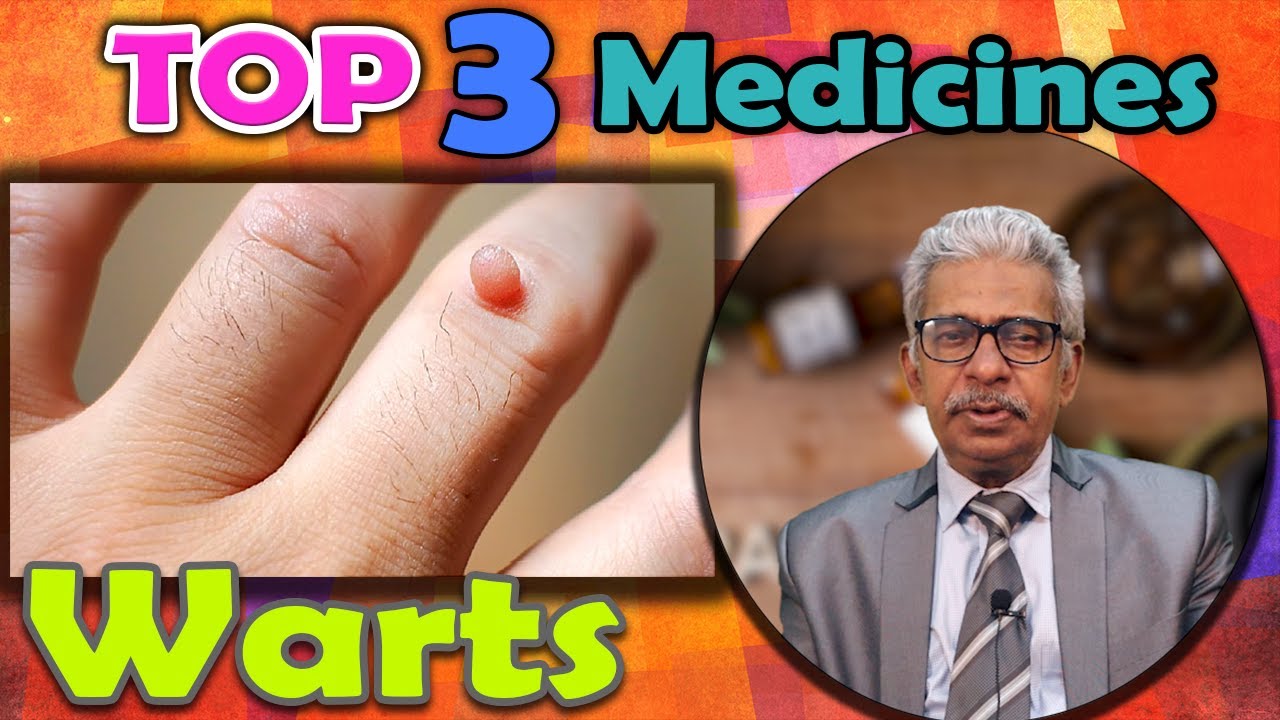 Top 3 Homeopathy Medicines For Warts Dr Ps Tiwari Youtube