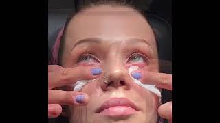 Undereye (Tear Trough) Injections with Restylane Filler | Dr. David P. Rapaport NYC